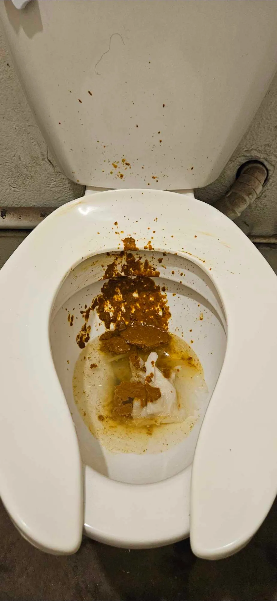 Lactose intolérance