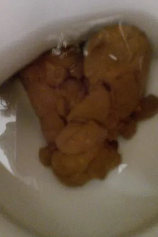 Lumpy poop