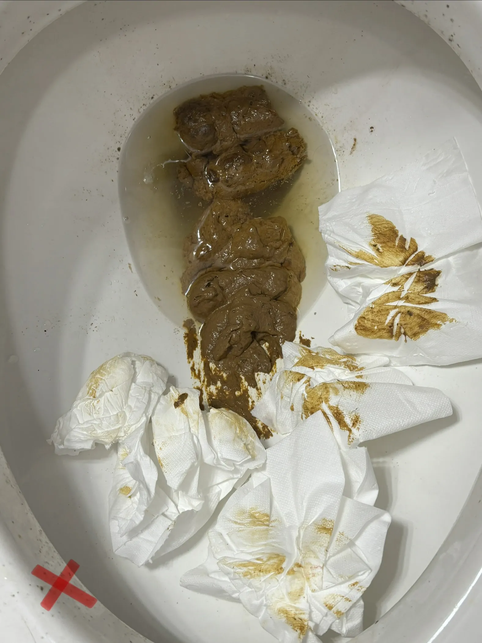 Lactose intolerance