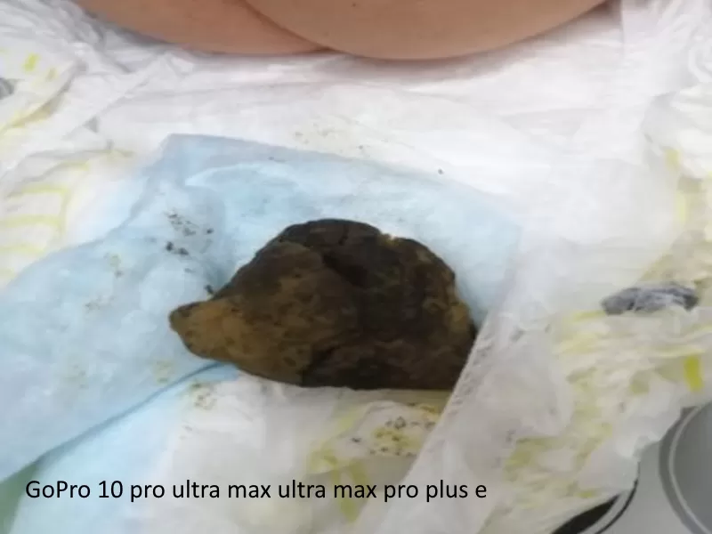 fecal ball